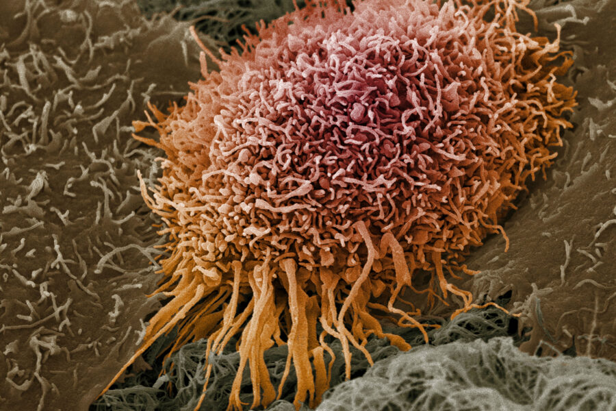 Image of a Human oral squamous cell carcinoma cell. Source: Wellcome Collection.